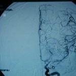 21D-tecnicas-endovasculares
