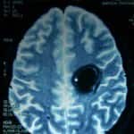 22-angioma-cavernoso información al paciente-patologia craneoencefalica-aneurismas y otras malformaciones vasculares-angioma-cavernoso