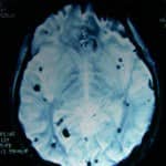 23-angioma-cavernoso-multiple información al paciente-patologia craneoencefalica-aneurismas y otras malformaciones vasculares-angioma-cavernoso-multiple