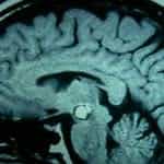 25-cavernoma-en-tronco-cerebral información al paciente-patologia craneoencefalica-aneurismas y otras malformaciones vasculares-cavernoma-en-tronco-cerebral