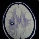 27A-RM-angioma-cavernoso información al paciente-patologia craneoencefalica-aneurismas y otras malformaciones vasculares-RM-angioma-cavernoso