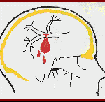 Esquema-aneurima-bifucacion-arteria-principal información al paciente-patologia craneoencefalica-aneurosmas y otras malformaciones vasculares-Esquema-aneurima-bifucacion-arteria-principal