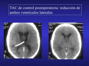 Hipertension endocraneana grave por hidrocefalia Casos clínicos - patologia LCR-Hipertension endocraneana grave por hidrocefalia