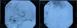 arteriografia-zona-vascularizada-tumor información al paciente-patologia craneoencefalica-meningioma parasital-arteriografia-zona-vascularizada-tumor