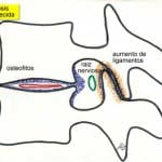 artrosis-establecida-A Informacion al paciente-patologia de columna vertebral-estenosis lumbar-artrosis-establecida-A