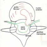 compresion-nervio-por-hernia-discal Informacion al paciente-patologia de columna vertebral-hernia discal lumbar-compresion-nervio-por-hernia-discal