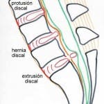 esquema-hernia-discal-protusion-discal Informacion al paciente-patologia de columna vertebral-hernia discal lumbar-esquema-hernia-discal-protusion-discal