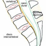 esquema-disco-intervertebral Informacion al paciente-patologia de columna vertebral-hernia discal lumbar-esquema-disco-intervertebral