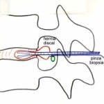 esquema-extracion-hernias-con-pinzas-especiales-A Informacion al paciente-patologia de columna vertebral-hernia discal lumbar-esquema-extracion-hernias-con-pinzas-especiales-A