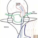 esquema-extracion-hernias-con-pinzas-especiales-B Informacion al paciente-patologia de columna vertebral-hernia discal lumbar-esquema-extracion-hernias-con-pinzas-especiales-B