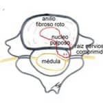 esquema-hernia-discal-A información al paciente-patologia columna vertebral-hernia fiscal cervical-esquema-hernia-discal-A