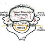 formacion-osteofitos-A información al paciente-patologia columna vertebral-hernia fiscal cervical-formacion-osteofitos-A