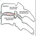 formacion-osteofitos-B información al paciente-patologia columna vertebral-hernia fiscal cervical-formacion-osteofitos-B