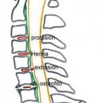 formas-afectacion-discal información al paciente-patologia columna vertebral-hernia fiscal cervical-formas-afectacion-discal