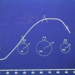 grafica-de-incremento-presion-intracraneal Informacion al paciente-patologia craneoencefalica-hidrocefalia comunicante-grafica-de-incremento-presion-intracraneal