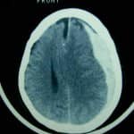 hematoma-subdural-agudo información al paciente-patologia craneoencefalica-hematoma-subdural-agudo