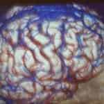 imagen-cerebro-venas-y-seno-longitudinal-superior información al paciente-patologia craneoencefalica-meningioma parasital-imagen-cerebro-venas-y-seno-longitudinal-superior