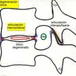 inicio-degeneracion-artrosica Informacion al paciente-patologia de columna vertebral-estenosis lumbar-inicio-degeneracion-artrosica
