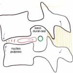 mecanismo-de-produccion-gernia-discal-A Informacion al paciente-patologia de columna vertebral-hernia discal lumbar-mecanismo-de-produccion-gernia-discal-A