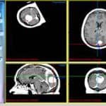 meningioma-en-neuronavegador información al paciente-patologia craneoencefalica-meningioma parasital-meningioma-en-neuronavegador