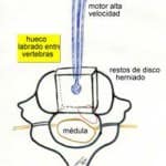 microdiscentomia información al paciente-patologia columna vertebral-hernia fiscal cervical-microdiscentomia