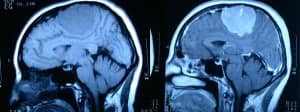 rm-con-y-sin-contraste-gran-meningioma información al paciente-patologia craneoencefalica-meningioma parasital-rm-con-y-sin-contraste-gran-meningioma