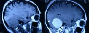 rm-con-y-sin-contraste-meningioma-cerebelo Informacion al paciente-patologia craneoencefalica-meningiomas-convexidad-cerebelosa-rm-con-y-sin-contraste-meningioma-cerebelo