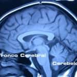 rm-craneal-tronco-cerebral-cerebelo Informacion al paciente-patologia craneoencefalica-meningiomas-convexidad-cerebelosa-rm-craneal-tronco-cerebral-cerebelo