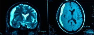 rm-en-t1-y-t2-hematoma información al paciente-patologia craneoencefalica-hematoma subdural-rm-en-t1-y-t2-hematoma