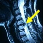 rm-lateral-cervical información al paciente-patologia columna vertebral-hernia fiscal cervical-rm-lateral-cervical