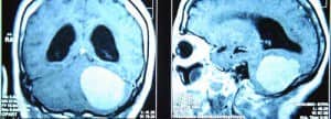 rm-meningioma-convexidad-con-hidrocefalia Informacion al paciente-patologia craneoencefalica-meningiomas-convexidad-cerebelosa-rm-meningioma-convexidad-con-hidrocefalia
