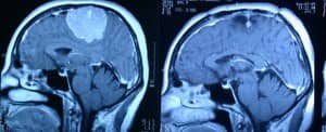 rm-pre-y-postoperatoria-extirpación-meningioma información al paciente-patologia craneoencefalica-meningioma parasital-rm-pre-y-postoperatoria-extirpación-meningioma