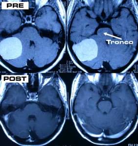rm-pre-y-postoperatorio-desaparicion-meningioma Informacion al paciente-patologia craneoencefalica-meningiomas-convexidad-cerebelosa-rm-pre-y-postoperatorio-desaparicion-meningioma