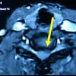 rm-transversal-cervical información al paciente-patologia columna vertebral-hernia fiscal cervical-rm-transversal-cervical