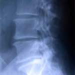 rx-columna-con-dismunicion-espacio-l4-l5 Informacion al paciente-patologia de columna vertebral-hernia discal lumbar-rx-columna-con-dismunicion-espacio-l4-l5