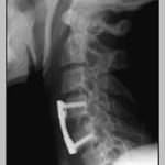 rx-lateral-cervical-postartrodesis información al paciente-patologia columna vertebral-hernia fiscal cervical-rx-lateral-cervical-postartrodesis