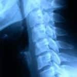 rx-lateral-columna-cervical información al paciente-patologia columna vertebral-hernia fiscal cervical-rx-lateral-columna-cervical