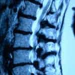 rx-lumbar-estenosis-varios-espacios Informacion al paciente-patologia de columna vertebral-estenosis lumbar-rx-lumbar-estenosis-varios-espacios