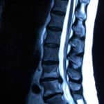 rx-lumbar-hernia-discal-en-espacio-l4-l5 Informacion al paciente-patologia de columna vertebral-hernia discal lumbar-rx-lumbar-hernia-discal-en-espacio-l4-l5