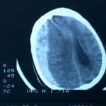 tac-colección-subdural-hiperdensa información al paciente-patologia craneoencefalica-hematoma subdural-tac-colección-subdural-hiperdensa