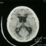 tac-craneal-indice-de-evans Informacion al paciente-patologia craneoencefalica-hidrocefalia comunicante-tac-craneal-indice-de-evans