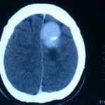 tac-craneal-lesion-meningioma información al paciente-patologia craneoencefalica-meningioma parasital-tac-craneal-lesion-meningioma