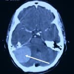 tac-craneal-meningioma-convexidad Informacion al paciente-patologia craneoencefalica-meningiomas-convexidad-cerebelosa-tac-craneal-meningioma-convexidad