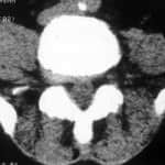 tac-lumbar Informacion al paciente-patologia de columna vertebral-hernia discal lumbar-tac-lumbar