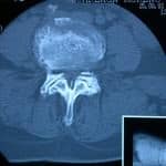 tac-lumbar-estenosis-severa Informacion al paciente-patologia de columna vertebral-estenosis lumbar-tac-lumbar-estenosis-severa