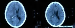 tac-pre-y-control-hematoma-subdural-cronico información al paciente-patologia craneoencefalica-hematoma subdural-tac-pre-y-control-hematoma-subdural-cronico