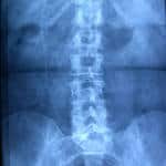 tx-abdomen.cateter-distal-valvula Informacion al paciente-patologia craneoencefalica-hidrocefalia comunicante-tx-abdomen.cateter-distal-valvula