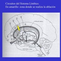 Casos clínico de neurocirugia funcional Dolor-cronico-cingulotomia-bilateral-estereotaxica-lateral