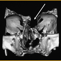 Casos clinicos-Patologias craneoencefalicas-encefalocele-frontonasal