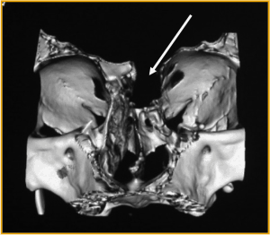 tac-craneal-3d-encefalocele-frontonasal Casos clinicos-Patologias craneoencefalicas-encefalocele-frontonasal